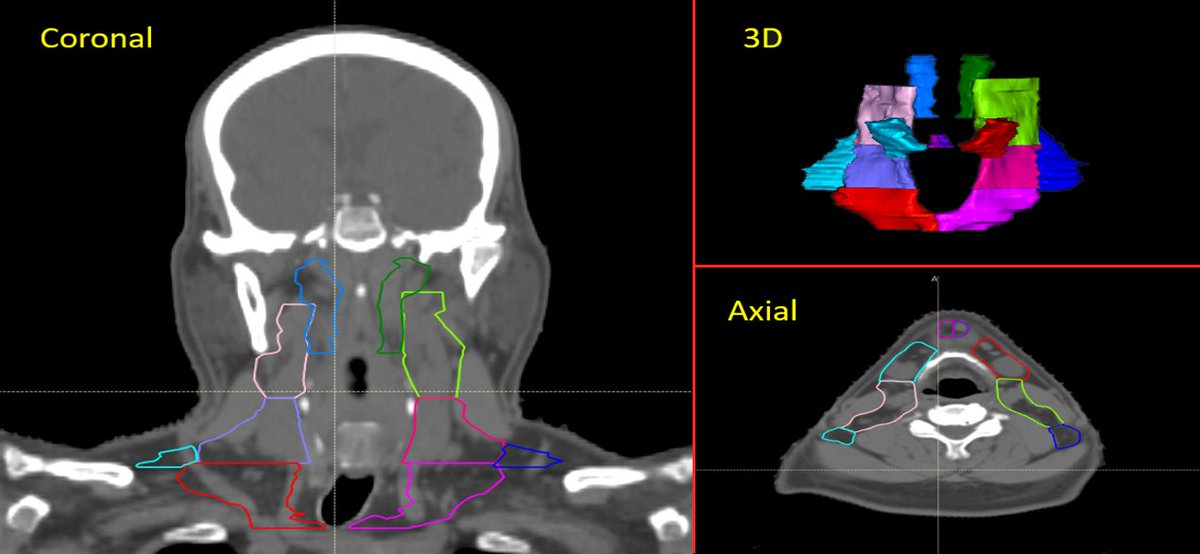 The recently published "RPA-Head-and-Neck-Lymph-Nodes" dataset includes CTs and RTSTRUCT contours of 7 lymph node levels from 46 subjects with definitive Oropharynx Cancer (OPX) to facilitate improved solutions for auto-contouring. Download it for free at doi.org/10.7937/FE3T-Z…