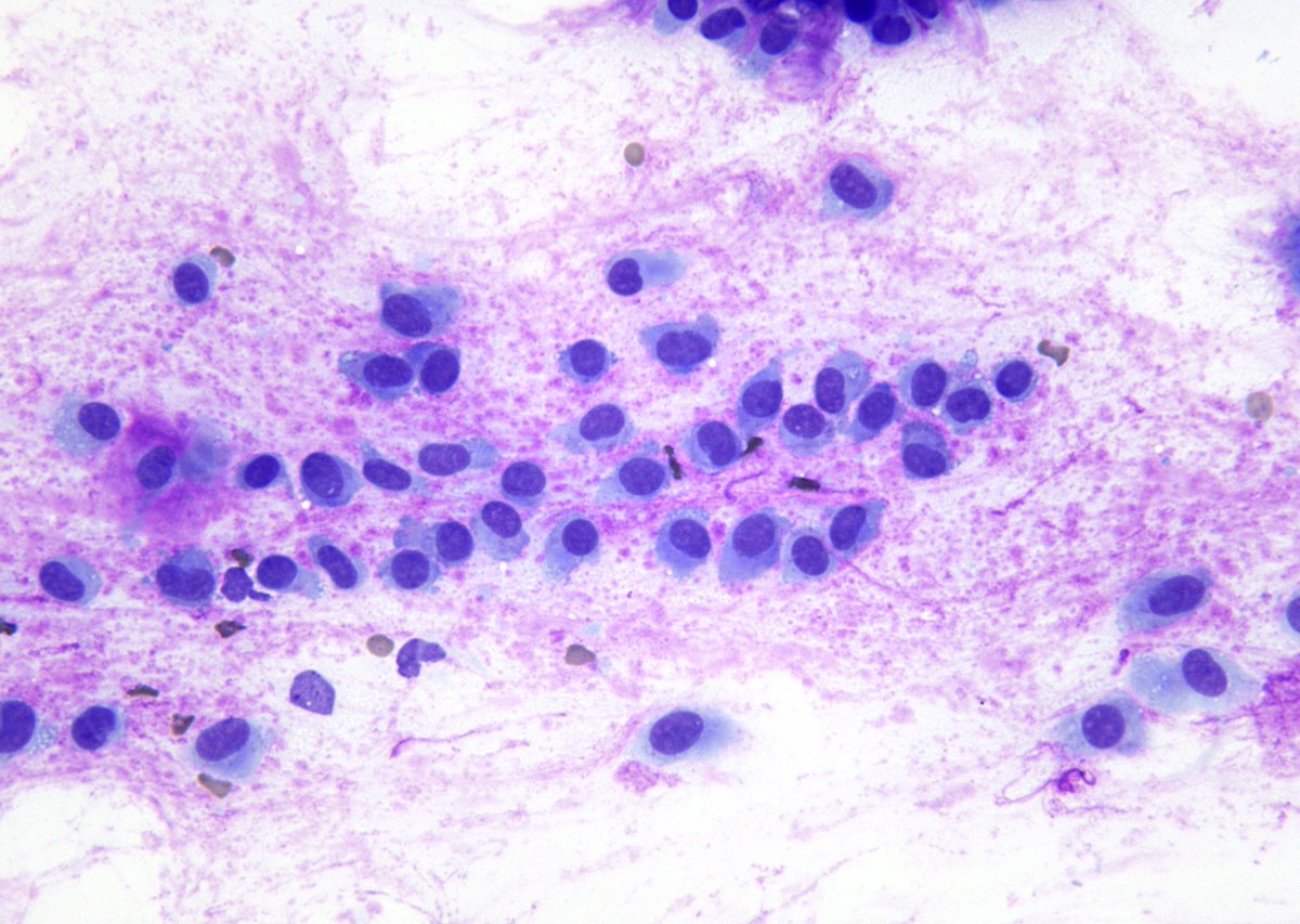 NOTHING is more satisfying in salivary gland cytopathology than a classic appearance of a "Pleomorphic Adenoma" on a good Giemsa stain. The myoepithelial cells are always so eye-catching when admixed with the granular background stroma.