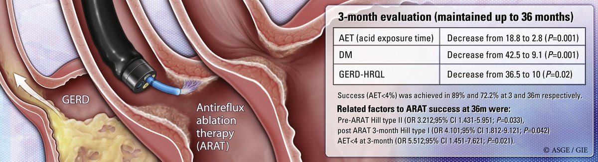 EndoCollabcom's tweet photo. 🔬ARAT: A promising, secure &amp; efficient option for treating GERD 🤢 in patients w/o sliding hiatal hernia 🚫.

More long-term analysis 📈 &amp; comparative studies 🧪 required for a clearer picture 🎯

Source: https://t.co/0OkWBQ65Kj https://t.co/zPBPPP5LuZ