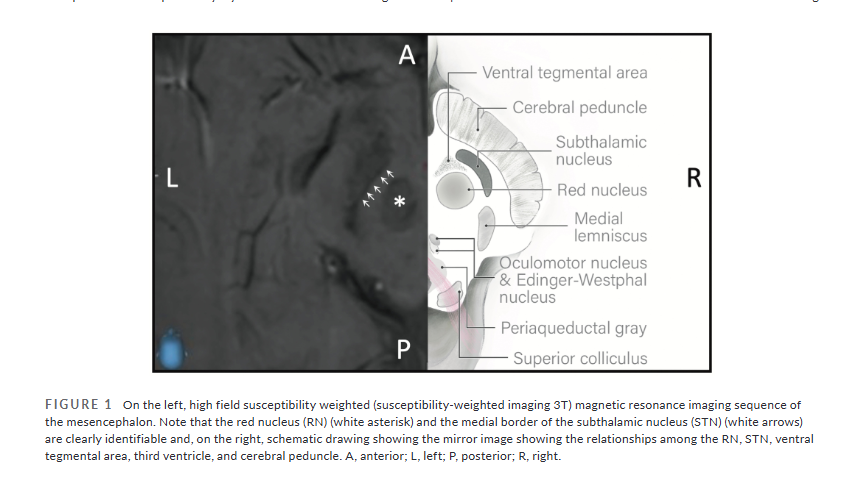 A case series about long term outcomes regarding deep brain stimulation for chronic refractory #ClusterHeadache finds a large number of these patients experienced long term benefit
…adachejournal.onlinelibrary.wiley.com/doi/full/10.11…
Juan Ángel Aibar-Durán MD, <a href="/NMorolln/">Noemí Morollón</a> <a href="/robertbelvis/">Robert Belvís</a> et al