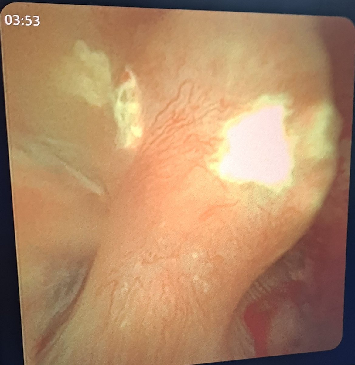 Randall's plaques, viewed by Flexible ureterorenoscopy. 
(جير راندال) هو ترسبات داخل جيوب الكلى يشتبه بكونها متسببه فى تكوين حصوات الكلى.
<a href="/Randall/">Randy</a>'s <a href="/plaque/">ㅤb</a> 
د. محمد بكر
مسالك بوليه