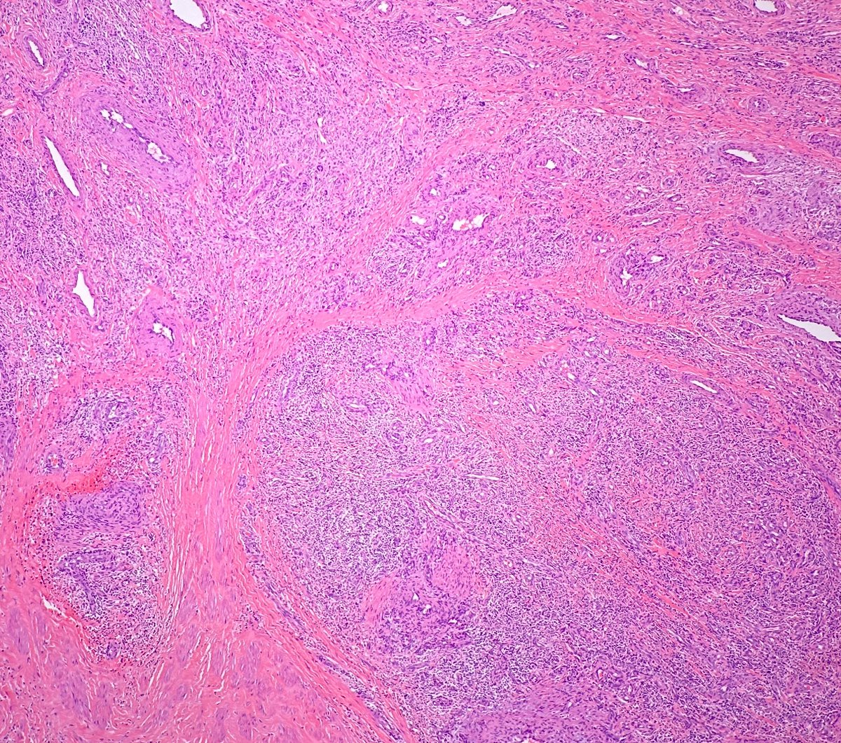 Path4People's tweet image. I am a benign rare chronic inflammatory disorder

I am often seen in young Asian males with a subcutaneous mass in the head&amp;amp;neck region

I am associated with peripheral 🩸 eosinophilia and raised IgE levels

Who am I? 🤔 #hemepath #dermpath #pathx #path4people #pathtwitter