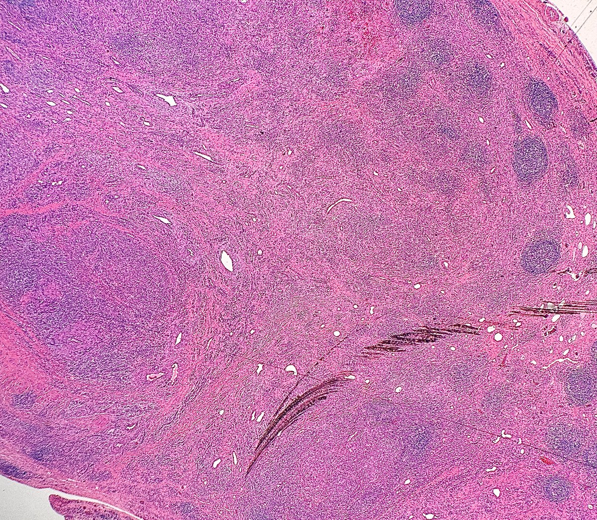 Path4People's tweet image. I am a benign rare chronic inflammatory disorder

I am often seen in young Asian males with a subcutaneous mass in the head&amp;amp;neck region

I am associated with peripheral 🩸 eosinophilia and raised IgE levels

Who am I? 🤔 #hemepath #dermpath #pathx #path4people #pathtwitter