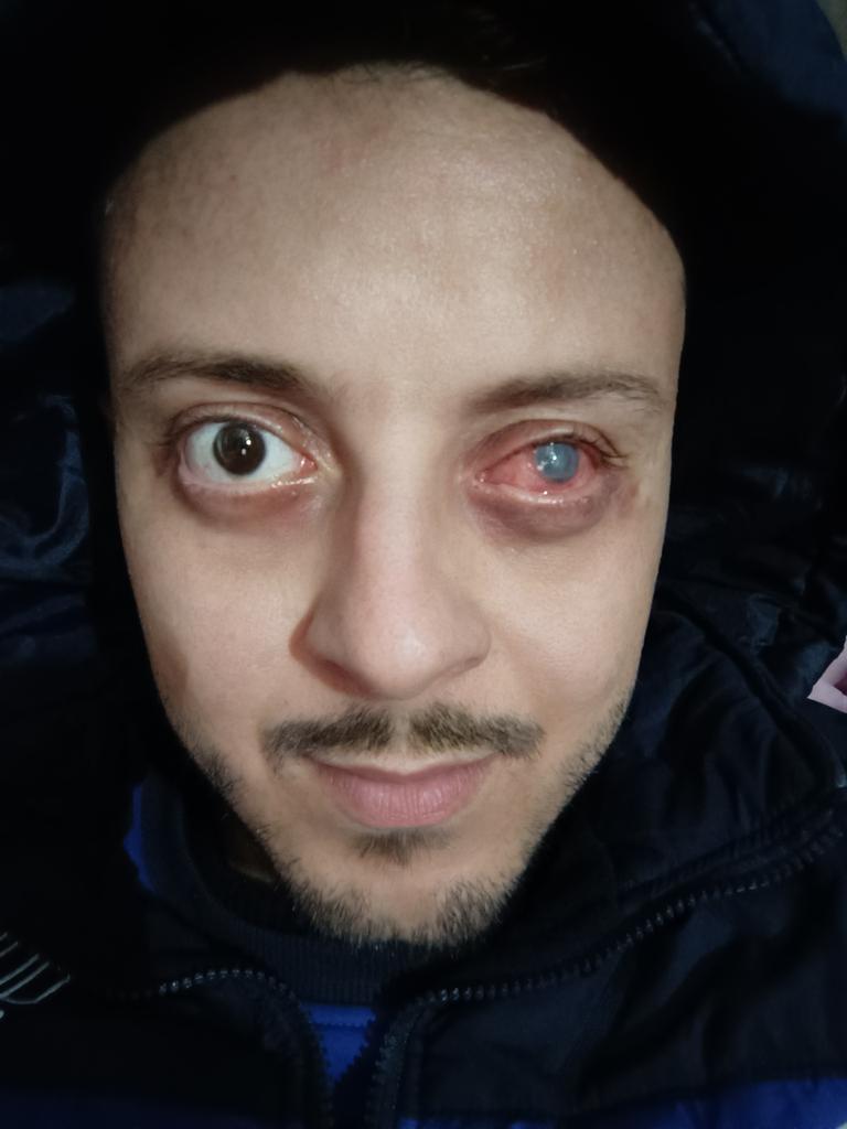 Living under pain and genocide in Gaza. 
Please pray for my eyes. 
gofund.me/3fd33d14