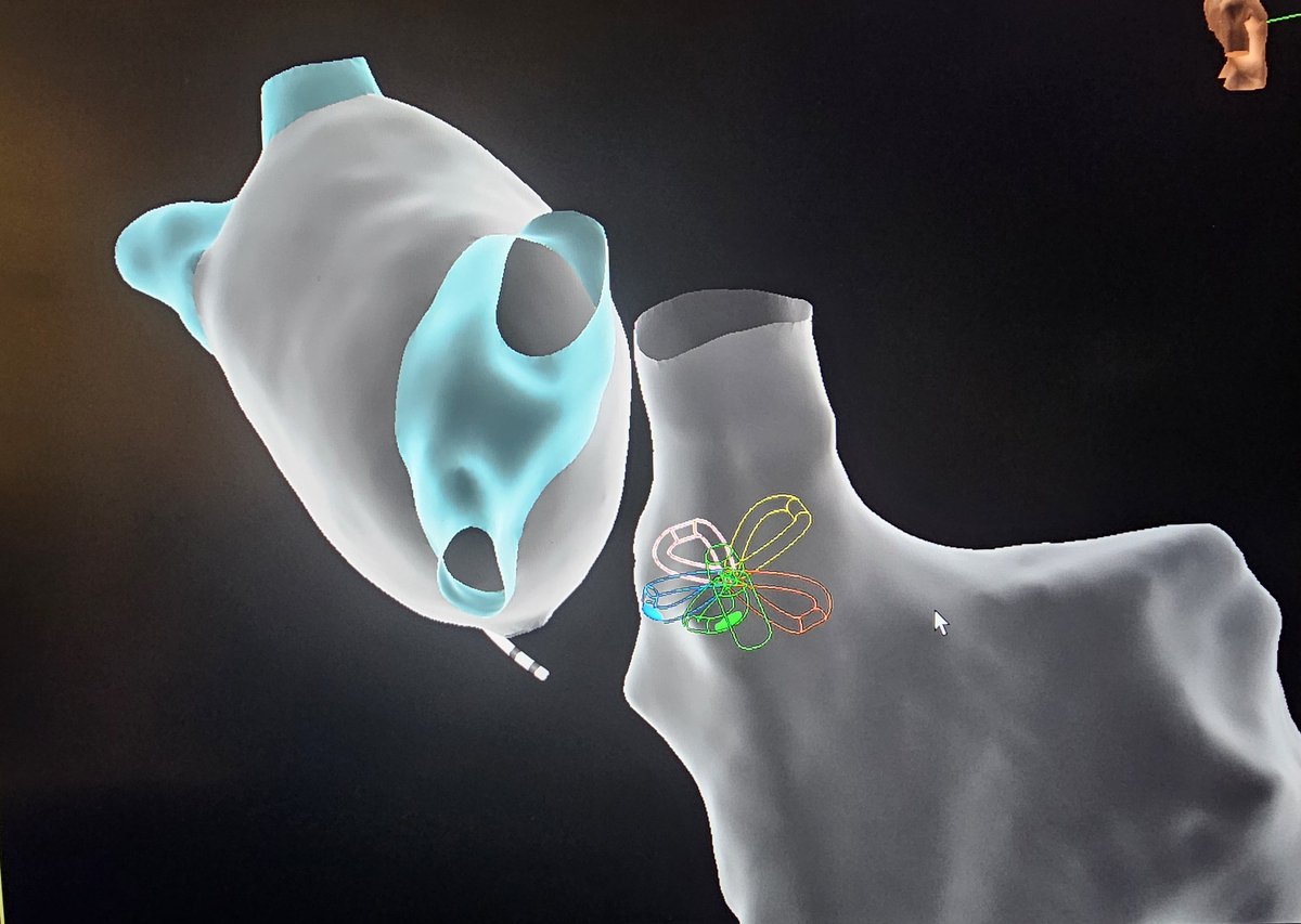 JuanBurnTerm's tweet image. ICE imaging from left to right?

Left sided ICE is a great way to visualize, not only the PVs and LAA, but also SVC and adjacent structures.

#MapMoreBurnLess
@AbbottCardio