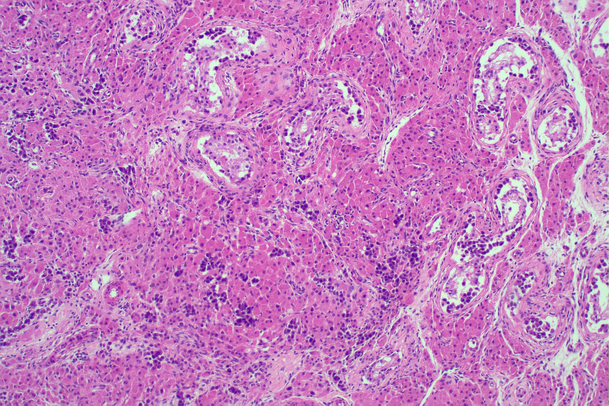 BeebsM1's tweet photo. Seminoma and very prominent / hyperplastic Leydig cells. Could the latter be related to finasteride (patient taking for hair loss) #gupath Haven't seen Leydig cells this prominent before... https://t.co/JVtNQy9TKv