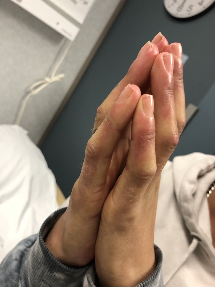 Janetbirdope's tweet image. What is the #sign?

#ClinicalPearl

hint Pt has #scleroderma #SSc