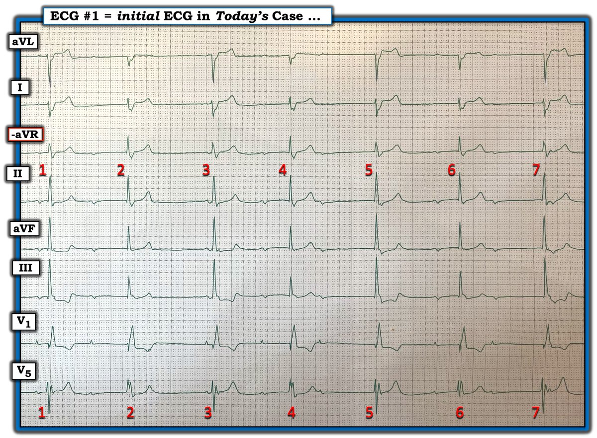 I was sent this ECG — and told that providers thought that the rhythm was 3rd-degree (ie, complete) AV block. — Do YOU agree? — GO TO — tinyurl.com/KG-Blog-458 —#ECG - #ECG_Ken_Grauer - #EKG — :)