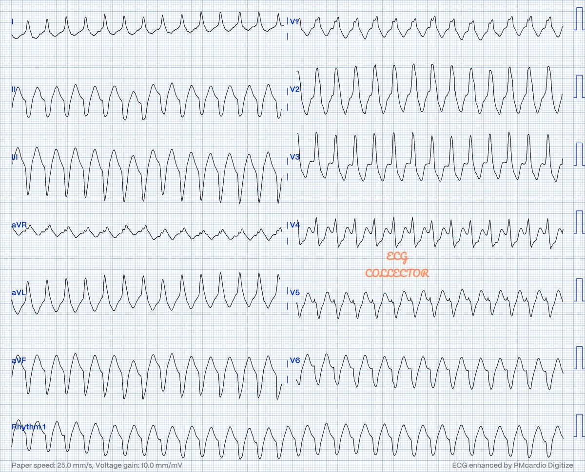 #ecg belongs to a 60+ y.o gentleman DM,HTN; chest discomfort &amp; palpitations; VS stable;

VT or SVT with aberrancy❓🤔

<a href="/PMcardioApp/">PMcardio—AI that reads ECGs</a> 
#Cardiology 
#CardioEd 
#Cardiotwitter 
#MedTwitter 
#Medicalstudent
