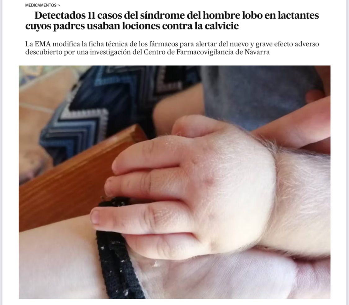 La noticia capilar de esta semana ha sido esta: "Detectados 11 casos del síndrome del hombre lobo en lactantes cuyos padres usaban lociones contra la calvicie". Unas notas sobre esto.