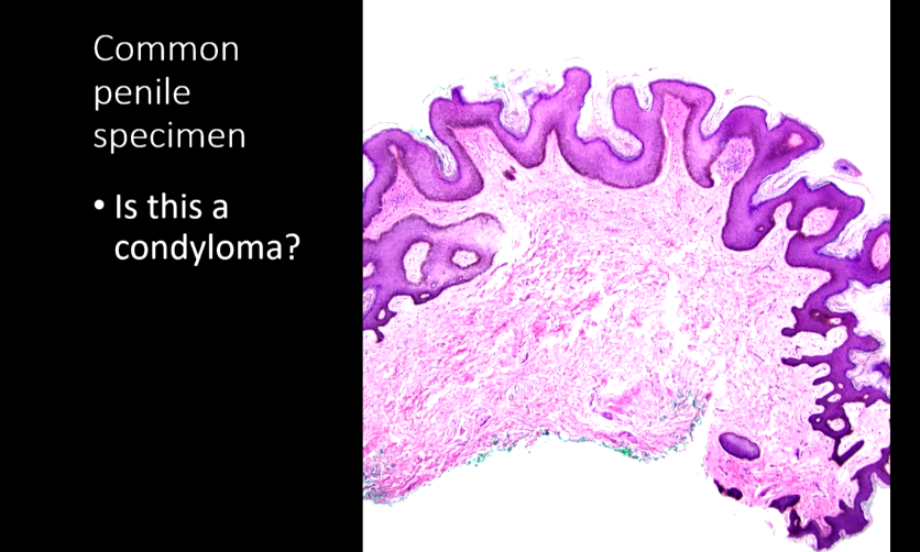 Janiranavarro's tweet image. Penile specimen: How do you call these lesions?
See next post 👇

Dr. Williamson #CAP24 #pathology #pathologists #PathTwitter #PathX #pathresidents #pathfellow #GUpath
