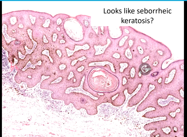 Janiranavarro's tweet image. Penile specimen: How do you call these lesions?
See next post 👇

Dr. Williamson #CAP24 #pathology #pathologists #PathTwitter #PathX #pathresidents #pathfellow #GUpath