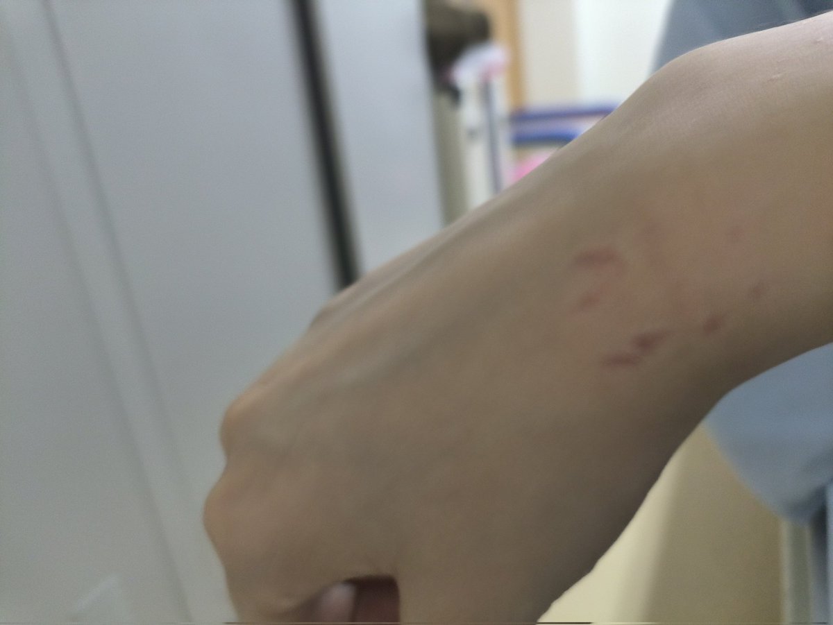 疯狂想自残的时候就会咬手。。。