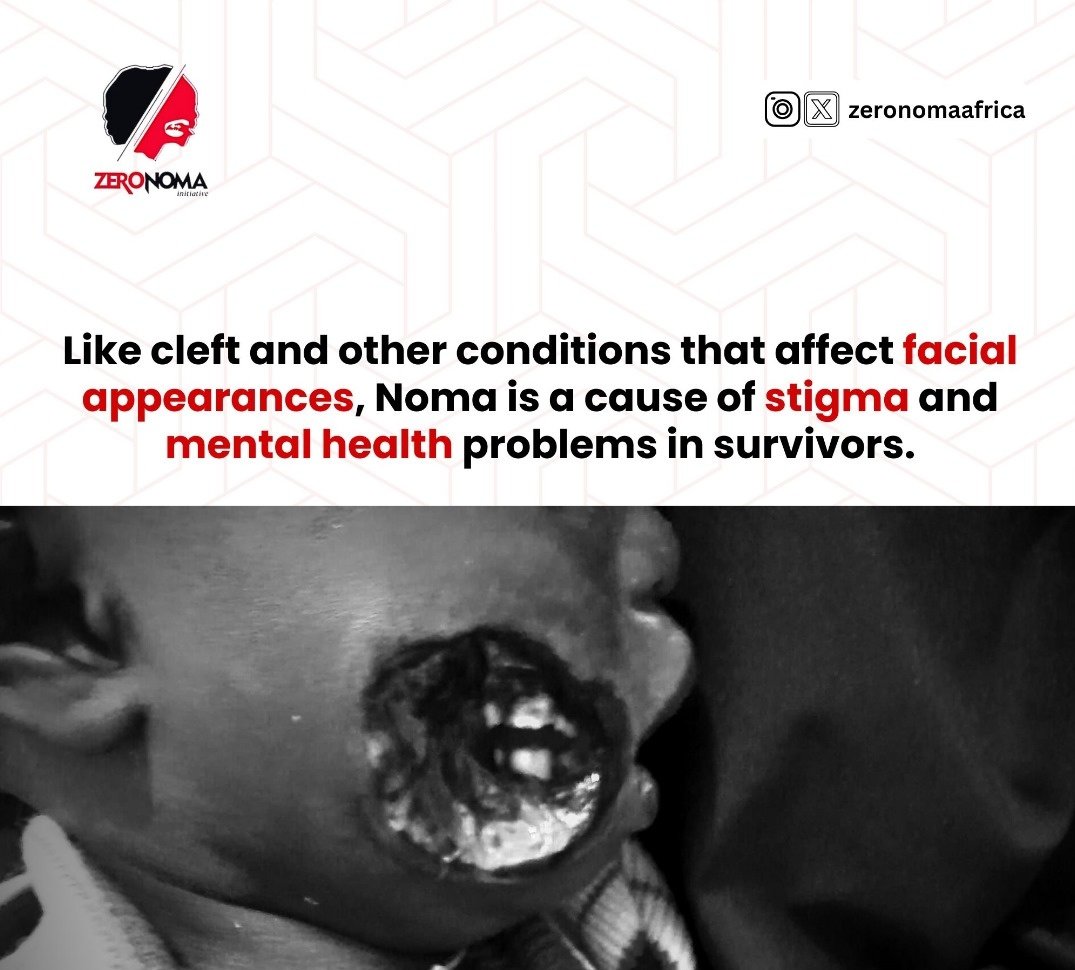 ZeronomaAfrica's tweet photo. Indeed, #Noma cause mental health problems for the survivors 

Day 35
#50DNA 
#Zeronoma
#ZeroStigma
#MentalHealthMatters 

@fiyinsiku 
@MentallyAwareNG 
@Meenabds https://t.co/UKFme8PRXZ