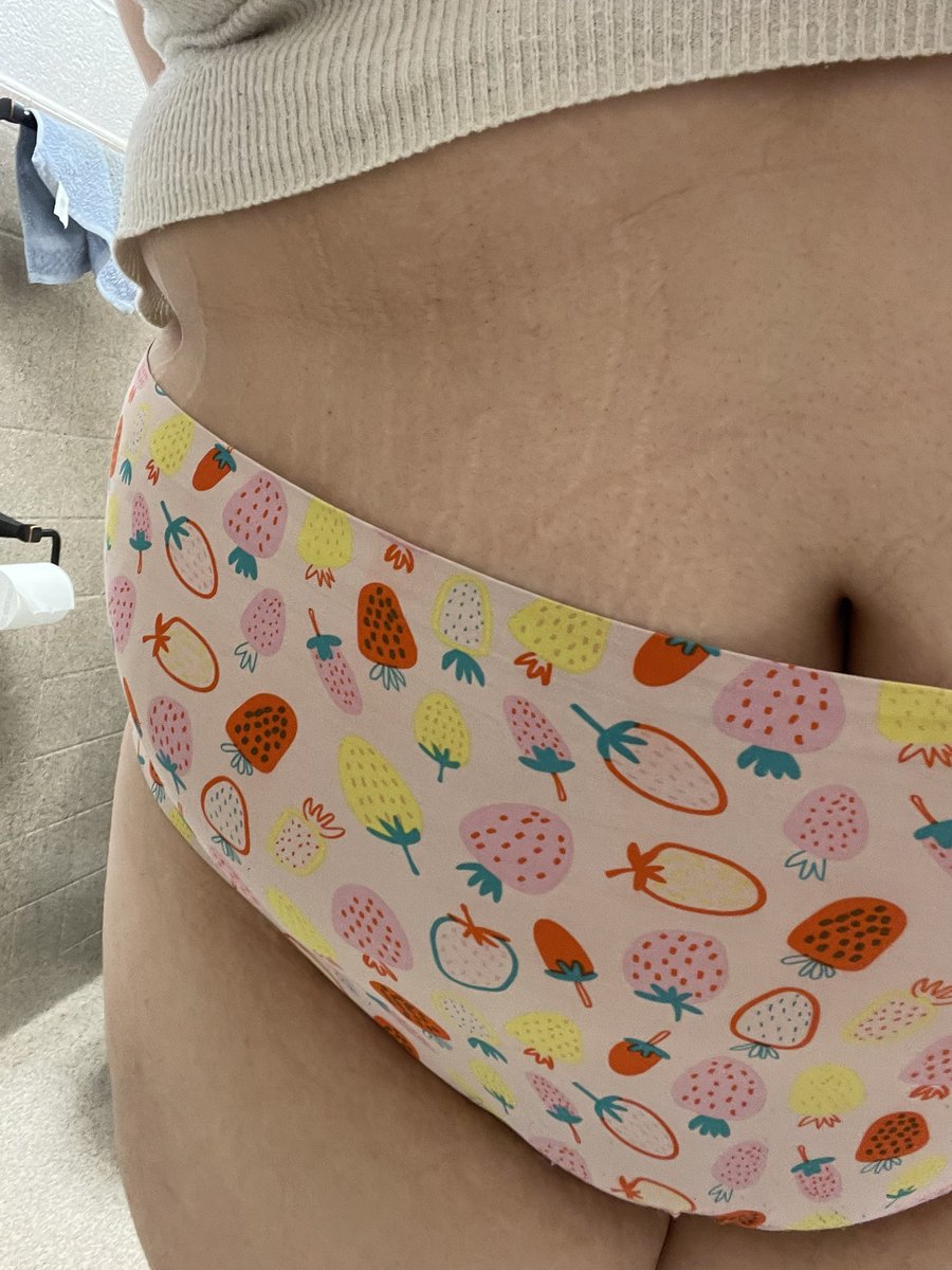 nowwhoshere's tweet photo. Marks and undies 😋
#selling_content #spoilme #onlyfans_girl #onlyfansfree #hornÿ #nsfwtwtًً #fatgirl #feedism #feeder https://t.co/ftNjbD6t3Y