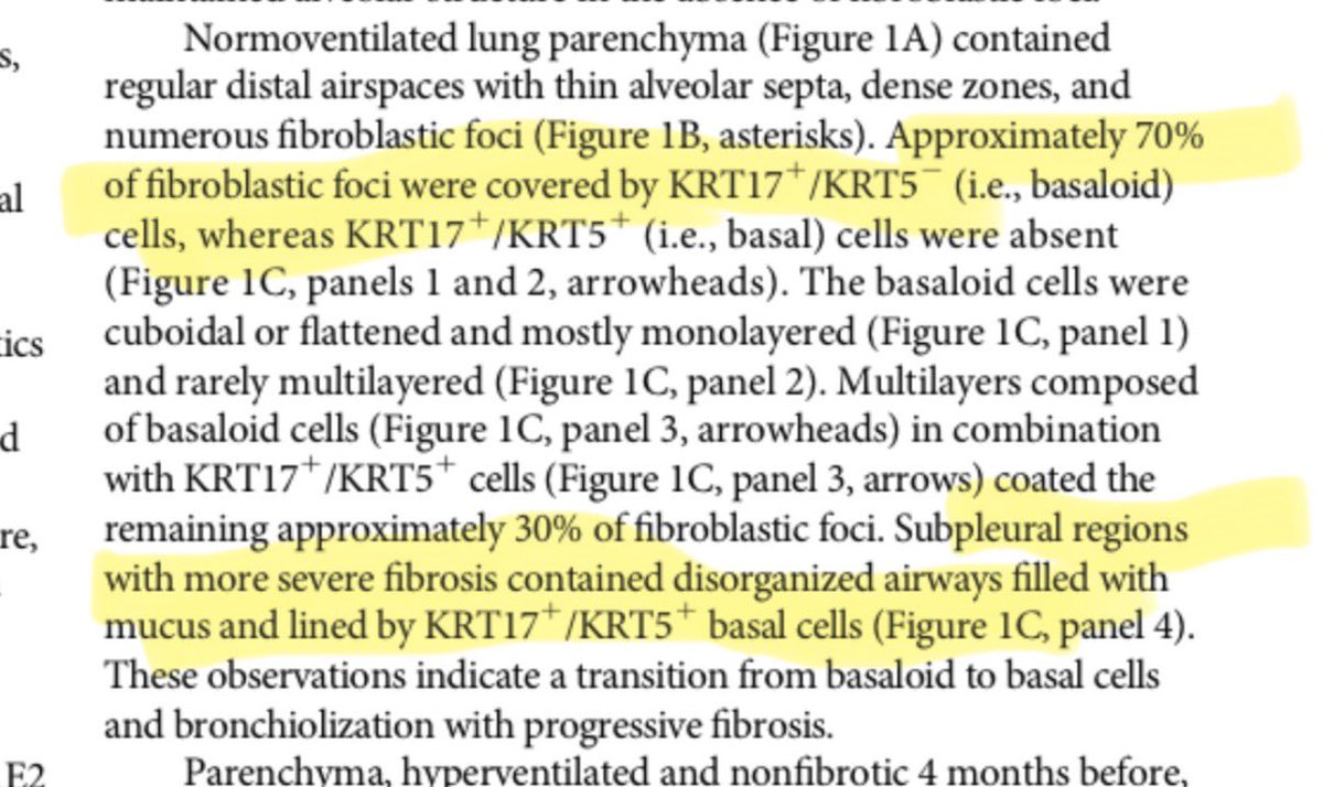 Did one of most important observations in #IPF research this year just get published as a letter with a cryptic title &amp; no abstract? 
I think so. 
Kudos Drs Schipke, Knudsen &amp; team for 1st ultrastuctural description of Aberrant Basaloid Cells in humans 👏🏼
atsjournals.org/doi/10.1165/rc…