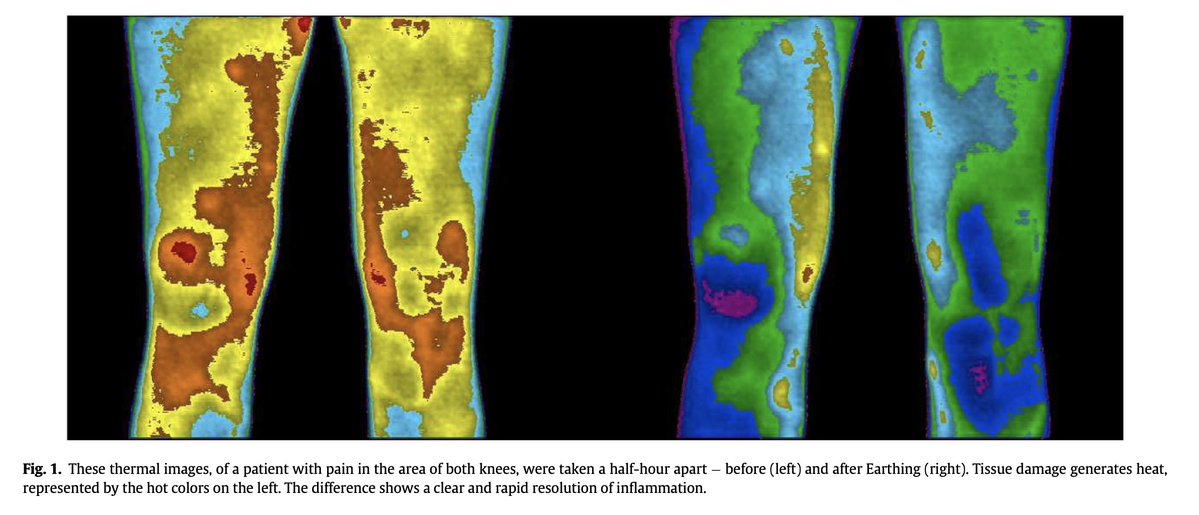 Outdoctrination's tweet photo. Near complete resolution of inflammation within an hour of grounding. 

Literally just by putting your feet on the earth (grass or soil).