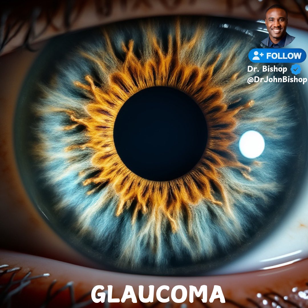 DrJohnBishop's tweet image. Glaucoma, often called the “silent thief of sight,” is a group of eye conditions that damage the optic nerve, which is essential for vision.

This damage is usually caused by abnormally high pressure in the eye (intraocular pressure). If left untreated, glaucoma can lead to…