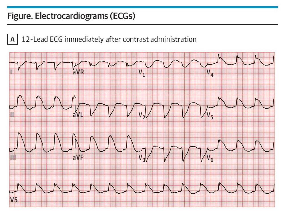 Case report: a woman in her early 60s who went into cardiac arrest immediately after administration of an echocardiogram contrast agent. ja.ma/4g8GkUW