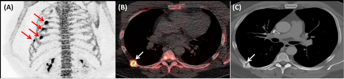 PuriTanuj's tweet photo. [18F]NaF PET-CT in Gorham-Stout Disease #18FNaF #nucmed #molrad #nuclearmedicine #nuclearradiology #molecularimaging #petct #petmri #precisionmedicine #precisionimaging #BoneResearch #ImagingInnovation #BoneImaging  #BoneRemodeling #EarlyDetection doi:10.1097/RLU.0000000000001369 https://t.co/QdyZBkuF2h