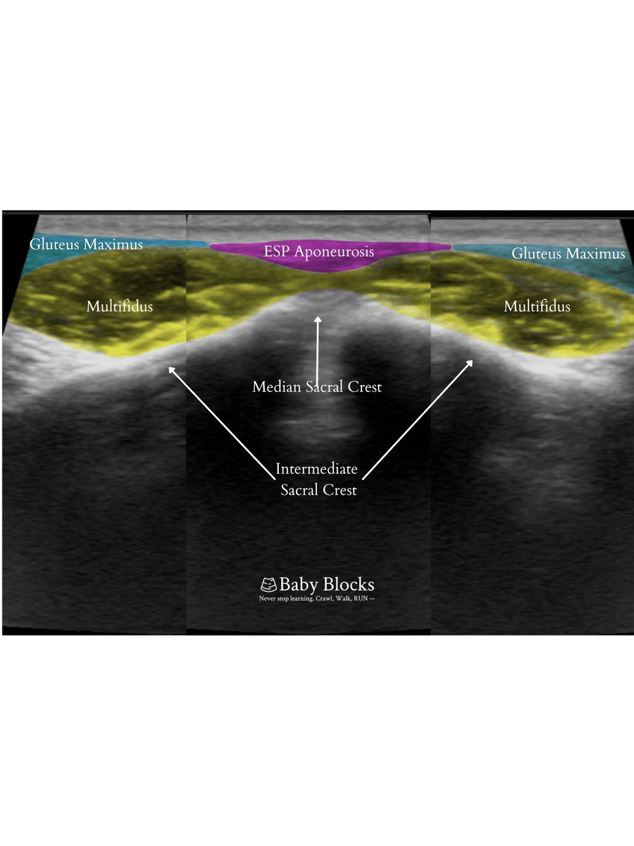 The Sacral Multifidus/ESP Block targets dorsal rami for sacral &amp; pelvic pain relief with minimal motor impairment. Its versatility makes it ideal for chronic pain &amp; postop relief—and it’s our most popular regional page of 2024!

baby-blocks.com/block-detail/s…