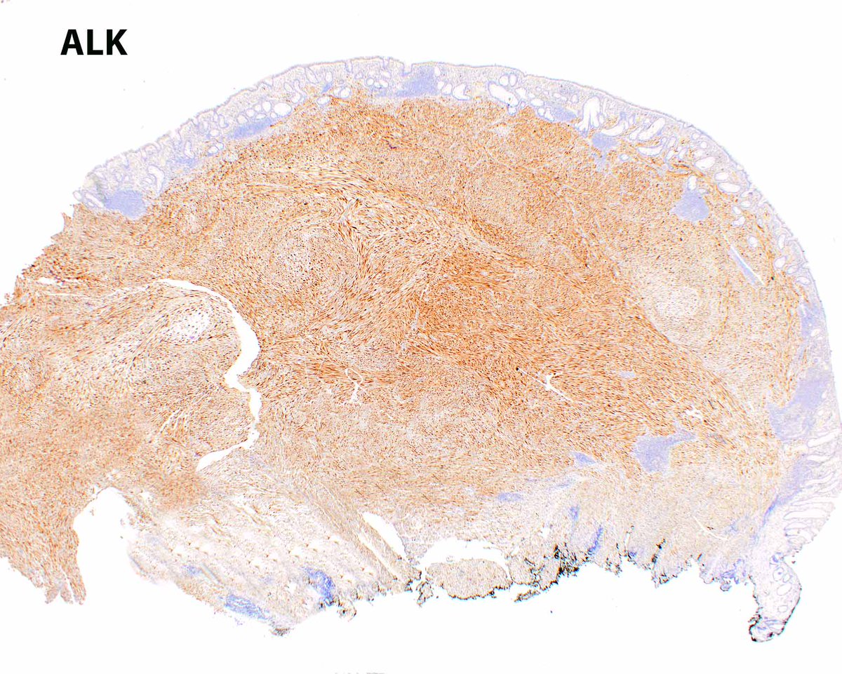 When inflammatory myofibroblastic tumor (IMT) extends into the submucosa and mucosa, it can mimic a gastrointestinal tract schwannoma because of its cuff of lymphoid aggregates.  Generally, IMTs are located in the mesentery and schwannomas in the muscularis propria. #UMiamiPath