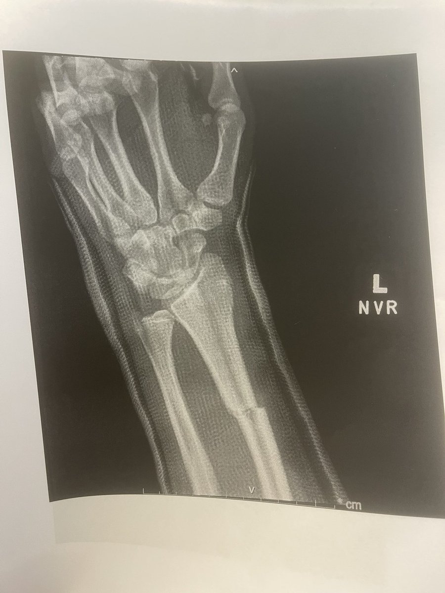 sharodtaylor26's tweet image. On 8/23/24 I suffered a severe arm and wrist injury that took me out for the rest of the regular season. I thought my junior season was over, but God had different plans. 9 weeks later, I’m back playing football with my brothers in the playoffs. This is my story, stay tuned💯