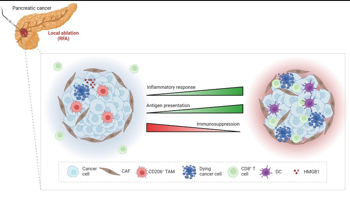 PancreasVerona's tweet photo. 🔥🔥off the press in Cancer Letters: Local ablation triggers immune-modulatory abilities in mouse/human PDAC models and human specimens. Combination with immunotherapy could reshape the microenvironment towards an anti-rumor milieu. https://t.co/0CLWfNDeja