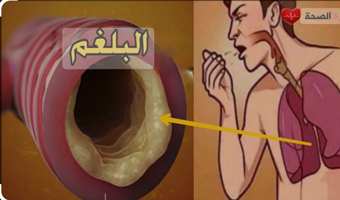 1Fali9's tweet image. كيفية إزالة البلغم من الحلق
إليك أهم المعلومات عن البلغم وطرق التخلص منه نهائيا اشرحها لكم تحت التغريدة .
لو مشغول فضلها وارجع لها بعدين 🤍