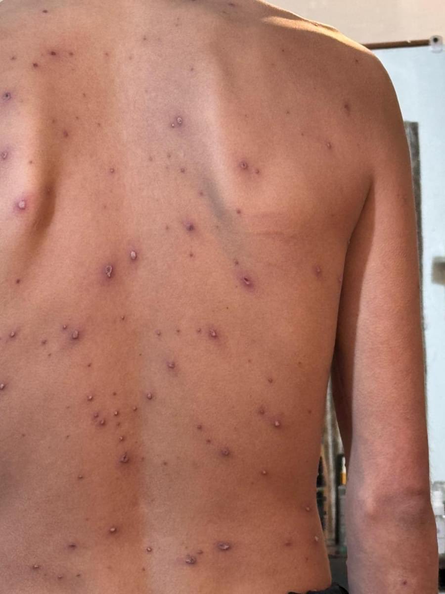 👨‍⚕️👨‍⚕️👨‍⚕️ Paciente con fiebre y lesiones en piel.
⬇️⬇️⬇️
.
.
.
Diagnóstico probable? 🩺🩺🩺