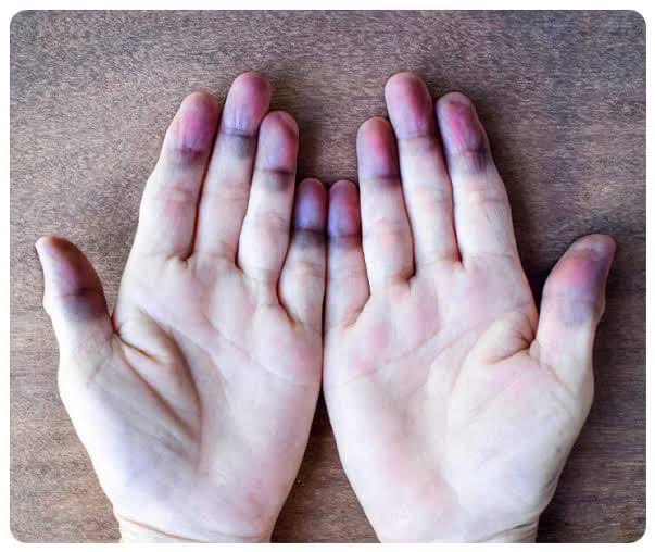 👨‍⚕️👨‍⚕️👨‍⚕️ Diagnóstico probable?
⬇️⬇️⬇️
.
.
.
Con qué enfermedades se relaciona? 🤔🤔🤨