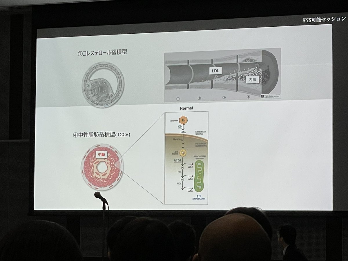 dr_reiji7's tweet photo. #TGCV
剖検例からも中性脂肪が中膜に。
コレステロールの蓄積型とは違う冠動脈病理に。
中野先生
#心リハ東海2024 https://t.co/Yywf5HyWFC