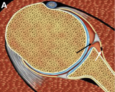 SportsMedReview's tweet photo. Dr Rubin looks at the nomenclature for types of shoulder labrum tears!

https://t.co/3L7DFjBXzD

#sportsmed #sportsmedicine #research #ebm #medicine #sports #foamSM #MedEd #FOAMed #ortho #medtwitter #medicine #doctor #resident #residency #medical #radiology #radiologist #medstudent #doctors #medicalstudent #orthotwitter #medschool #medicallife #doctormotivation #medschool #futuredoctor #orthopedicsurgeon #orthopedics #athletictraining