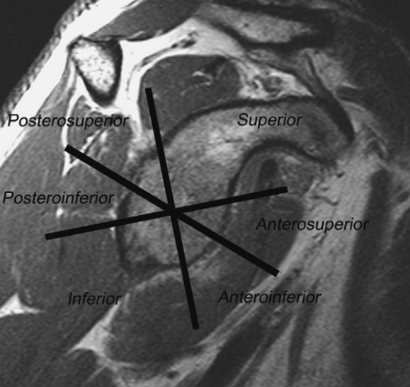 SportsMedReview's tweet photo. Dr Rubin looks at the nomenclature for types of shoulder labrum tears!

https://t.co/3L7DFjBXzD

#sportsmed #sportsmedicine #research #ebm #medicine #sports #foamSM #MedEd #FOAMed #ortho #medtwitter #medicine #doctor #resident #residency #medical #radiology #radiologist #medstudent #doctors #medicalstudent #orthotwitter #medschool #medicallife #doctormotivation #medschool #futuredoctor #orthopedicsurgeon #orthopedics #athletictraining