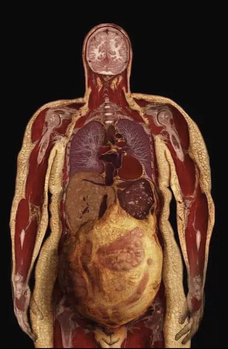 NOgymNOlimits's tweet image. No sólo es cuestión de verse gordo o delgado.

La grasa DESTRUYE tu salud y ACORTA tu vida.

Y este es el porqué 🧵👇