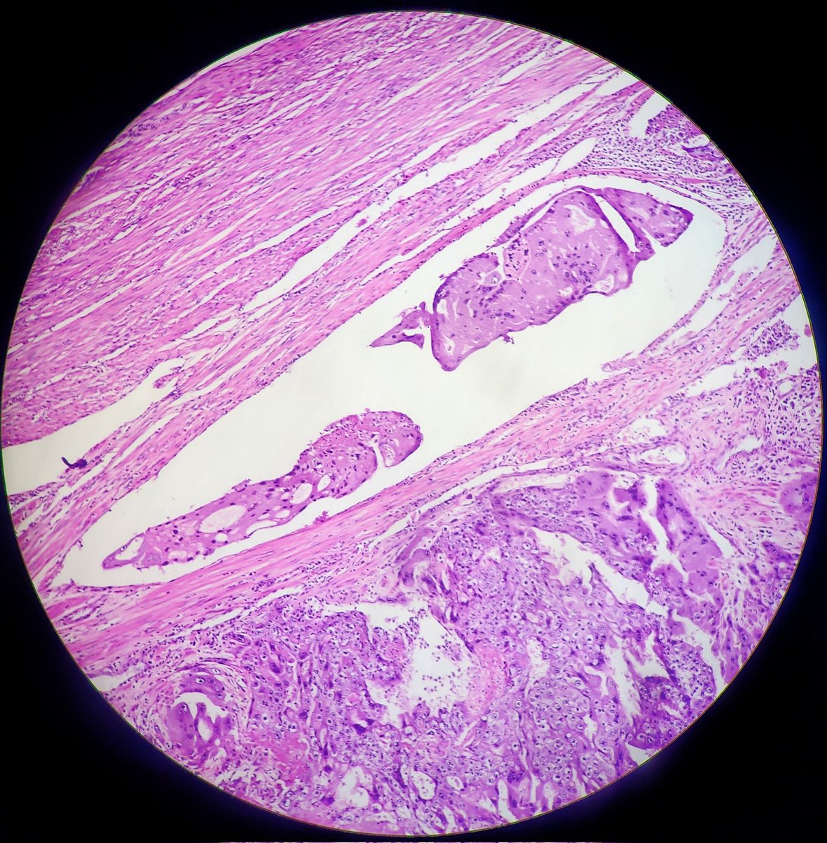 SyedSal55391459's tweet photo. #histopathology
#uterus
#neoplasm
#trophoblasts
#pathX
#pathTwitter
Dx: Choriocarcinoma.
Vascular invasion is noted. https://t.co/aDHY4USECs