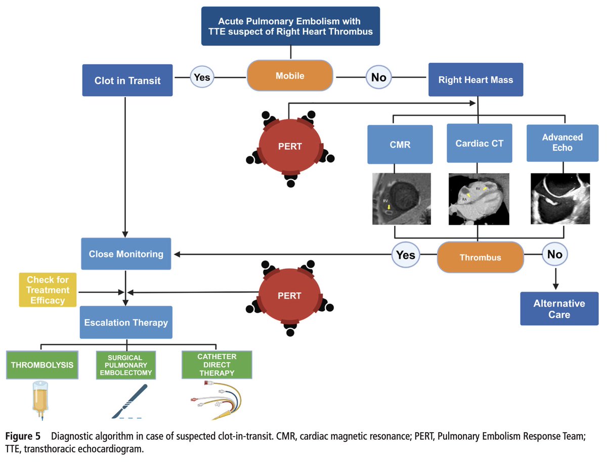 Edgardo Alania (@ed_alania) on Twitter photo 🔴 Clot-in-transit & pulmonary embolism: an urgent call for awareness and action <a href="/Heart_BMJ/">Heart_BMJ</a> #cardioEd #Cardiology #CardioTwitter #echofirst 🔴 Clot-in-transit & pulmonary embolism: an urgent call for awareness and action <a href="/Heart_BMJ/">Heart_BMJ</a> #cardioEd #Cardiology #CardioTwitter #echofirst