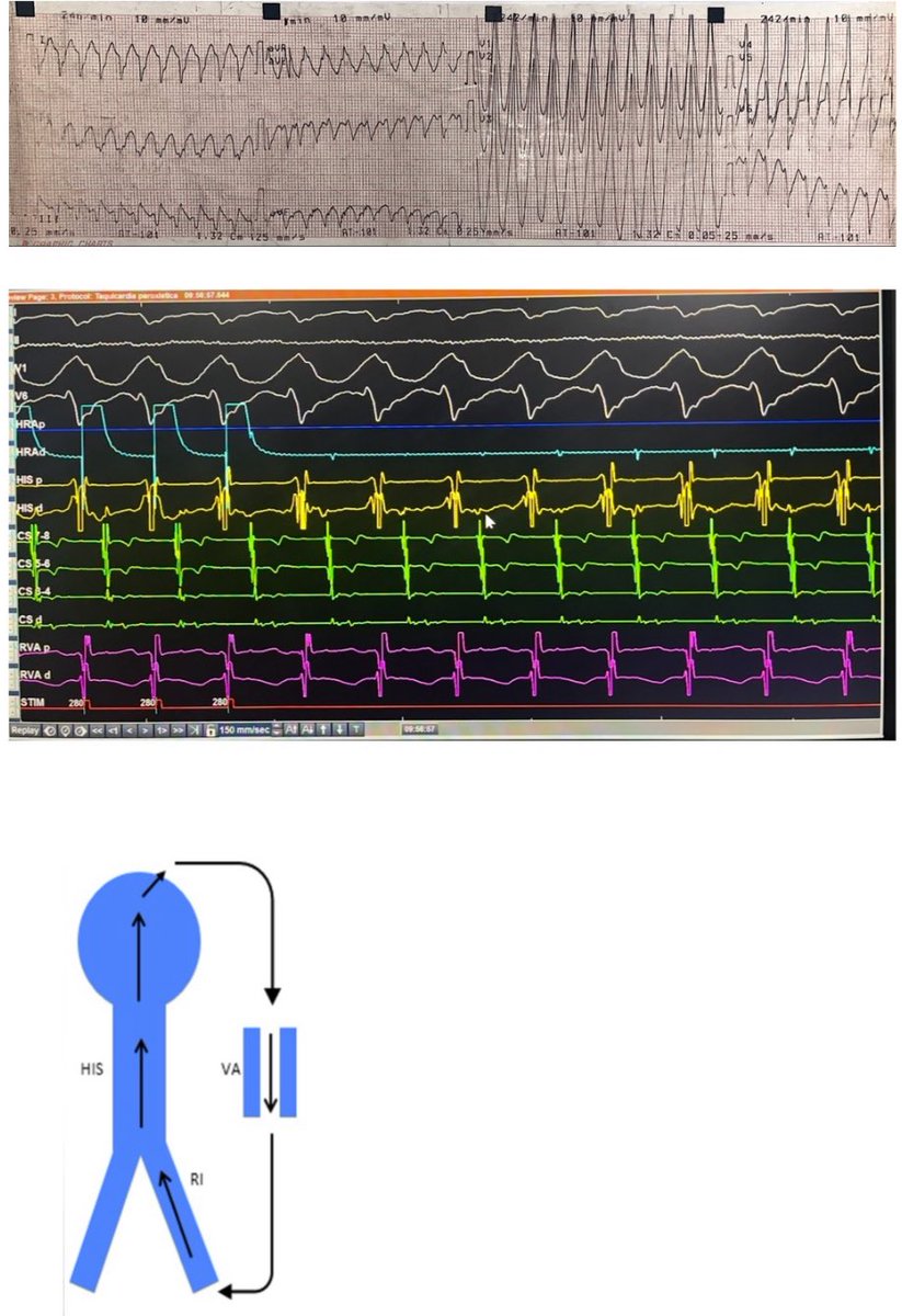 45 yo male, morbid obesity w/ PMHx of WPW syndrome &amp; documented regular WCT.

Antidromic Reentrant tachycardia (ART) using a left lateral AP as anterograde limb &amp; AVN as retrograde limb. 

Duodromic tach  w/presence of septal AP r/o w/pacing maneuvers

Retro AV conduction 260 ms