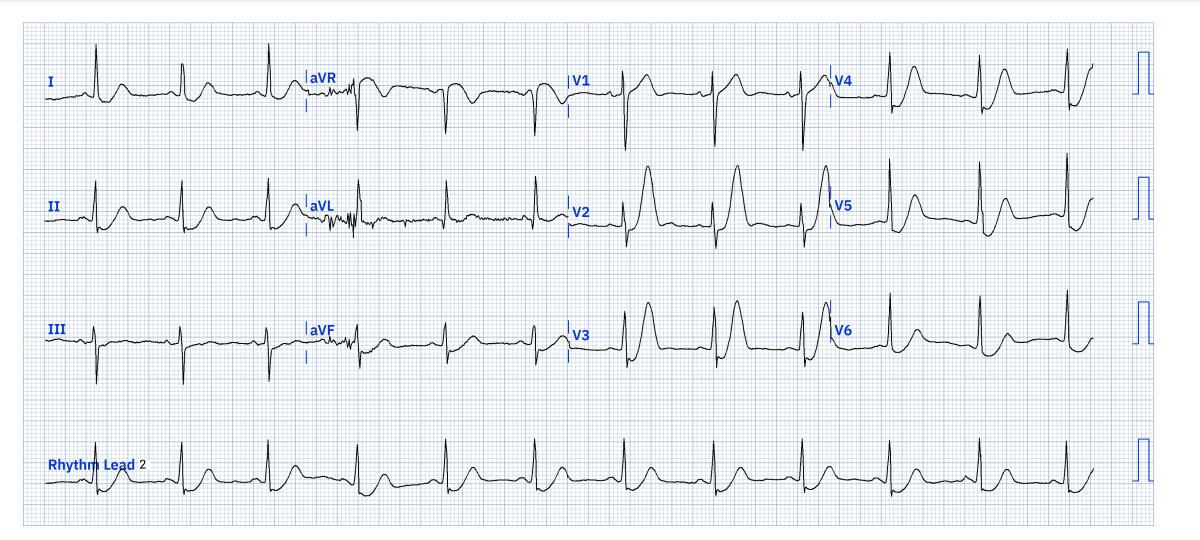 82-year-old female with nausea and dizziness... What's your take on ecg?
#ecg #cardiology #medtwitter