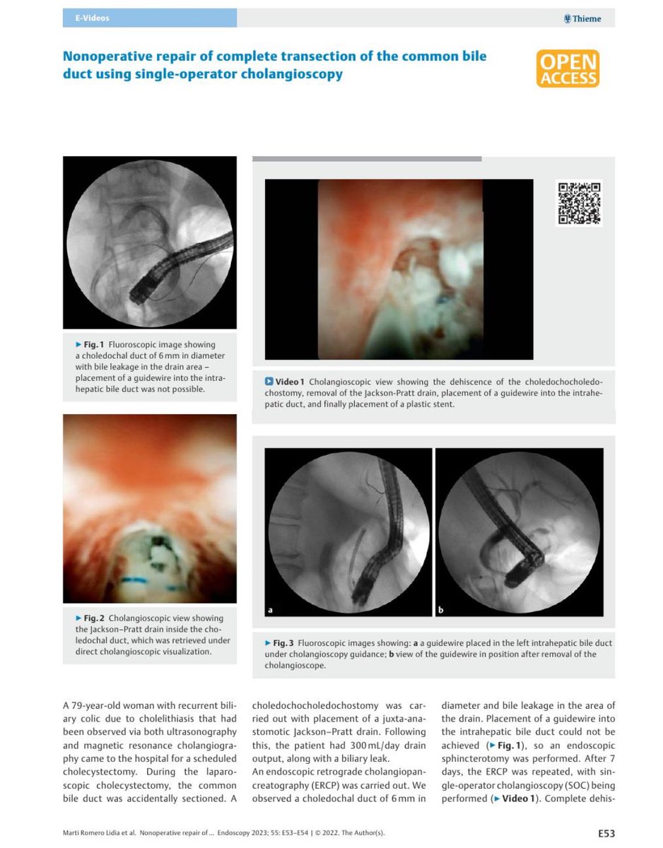 <a href="/DouglasAdlerMD/">Douglas G. Adler MD, FASGE, FACG, AGAF</a> <a href="/jeanvemer/">Andrea Velasquez</a> <a href="/asge/">Aslak Gottlieb</a> <a href="/GIE_Journal/">GIE</a> Antibiotics and in some cases we repared coledocal transection with spyGlass avoiding surgery. We published something similar here: pmc.ncbi.nlm.nih.gov/articles/PMC98…