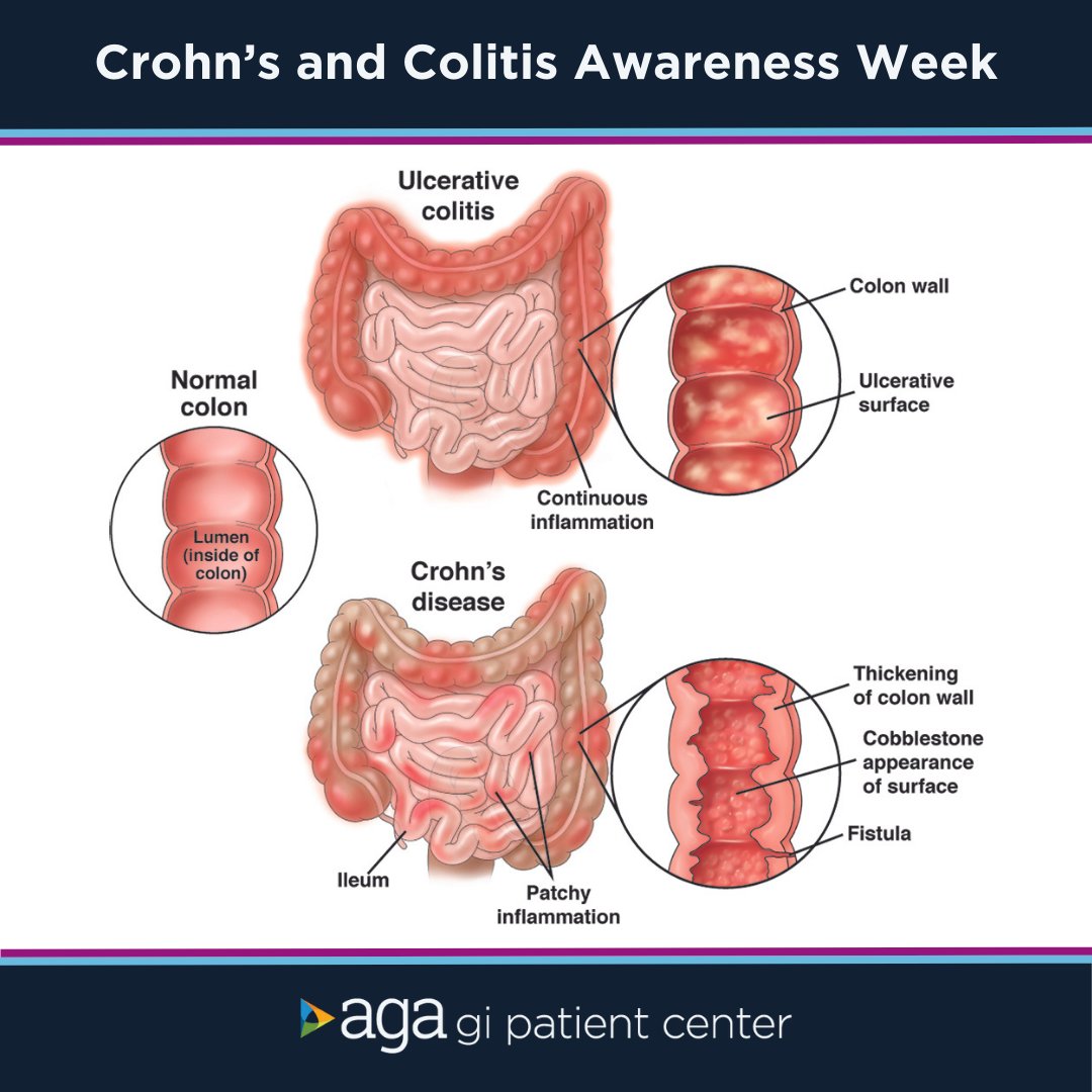 AmerGastroAssn's tweet image. We stand with IBD warriors and caregivers to make #IBDvisible during #Crohn’s and Colitis Awareness Week. 💜 #CCAwarenessWeek