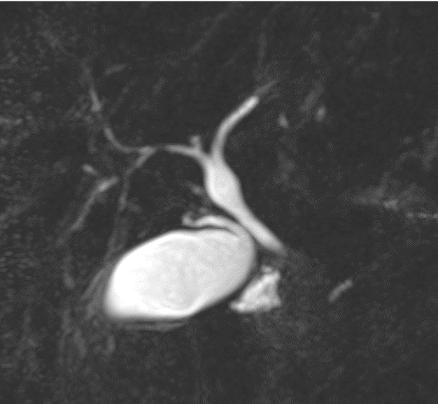 SAR DFP Benign Biliary Pathology (@sarbiliarydfp) on Twitter photo Challenge yourself with another biliary case: Case courtesy of Daniel R. Phadke from UVA Radiology
<a href="/UVARadiology/">UVA Radiology</a>
44 yo woman with history of epigastric and left upper quadrant pain Challenge yourself with another biliary case: Case courtesy of Daniel R. Phadke from UVA Radiology
<a href="/UVARadiology/">UVA Radiology</a>
44 yo woman with history of epigastric and left upper quadrant pain