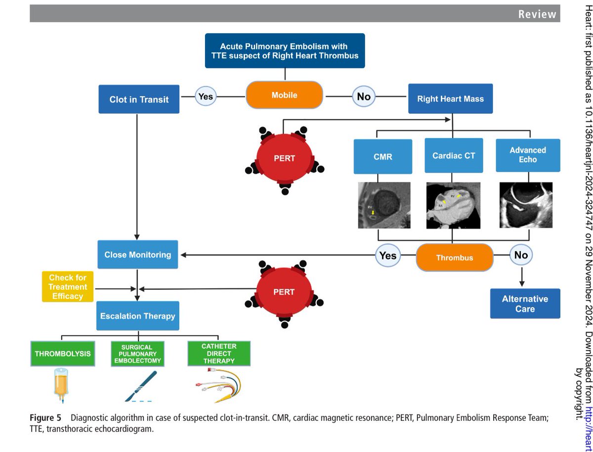 Mamas A. Mamas (@mmamas1973) on Twitter photo Pulmonary embolism and clot in transit- a proposed algorithm where the role of the Pulmonary Embolism Response Team (PERT) is highlighted for risk stratification and treatment
Work led by <a href="/MZimarino/">Marco Zimarino</a> and mario di marino and friends
Link to paper ➡️heart.bmj.com/content/early/…
Thank Pulmonary embolism and clot in transit- a proposed algorithm where the role of the Pulmonary Embolism Response Team (PERT) is highlighted for risk stratification and treatment
Work led by <a href="/MZimarino/">Marco Zimarino</a> and mario di marino and friends
Link to paper ➡️heart.bmj.com/content/early/…
Thank