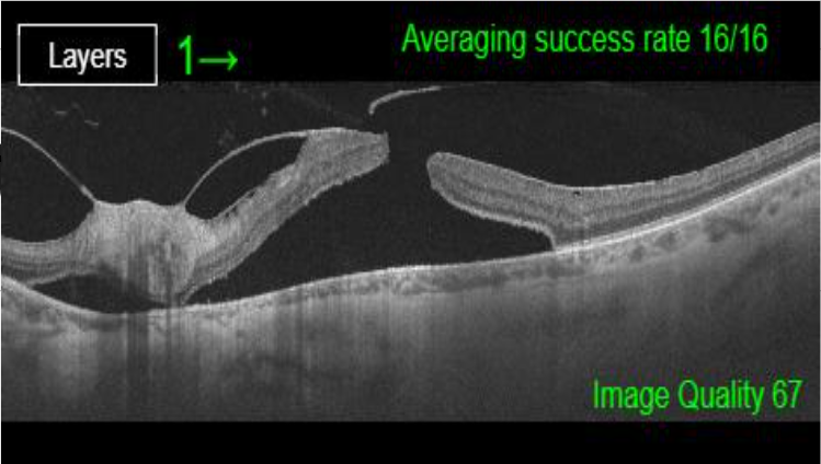RetinaSERV's tweet photo. 👨‍⚕️Este varón de 68 años presenta una fuerte tracción vitreomacular que ha dado lugar a un agujero macular con presencia de desprendimiento de retina macular. https://t.co/dteMeT6nF3