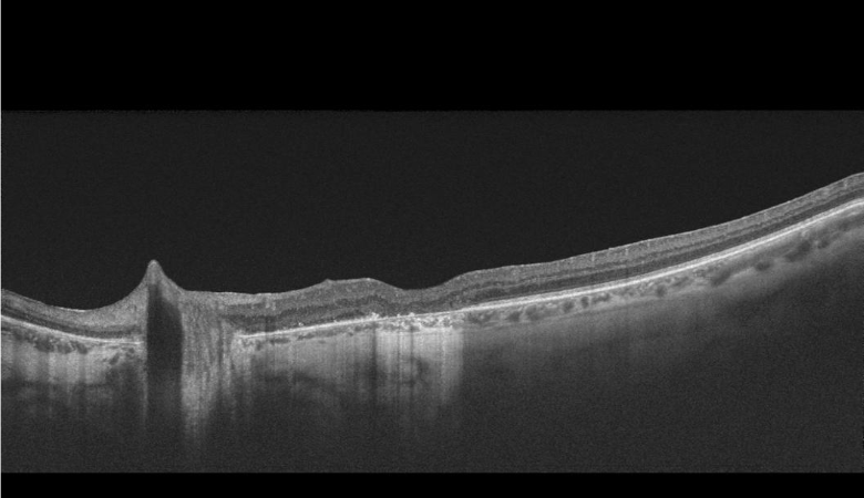 RetinaSERV's tweet photo. 👨‍⚕️Este varón de 68 años presenta una fuerte tracción vitreomacular que ha dado lugar a un agujero macular con presencia de desprendimiento de retina macular. https://t.co/dteMeT6nF3