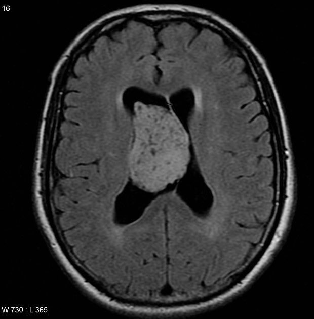 Dr.Haitham Hamoud | د.هيثم (@hemo_shk) on Twitter photo Patients presents with vomiting, homonymous visual field defects and headache
What is the diagnosis?
#MEDHM #MedX <a href="/IhabFathiSulima/">Dr Ihab Suliman</a> Patients presents with vomiting, homonymous visual field defects and headache
What is the diagnosis?
#MEDHM #MedX <a href="/IhabFathiSulima/">Dr Ihab Suliman</a>
