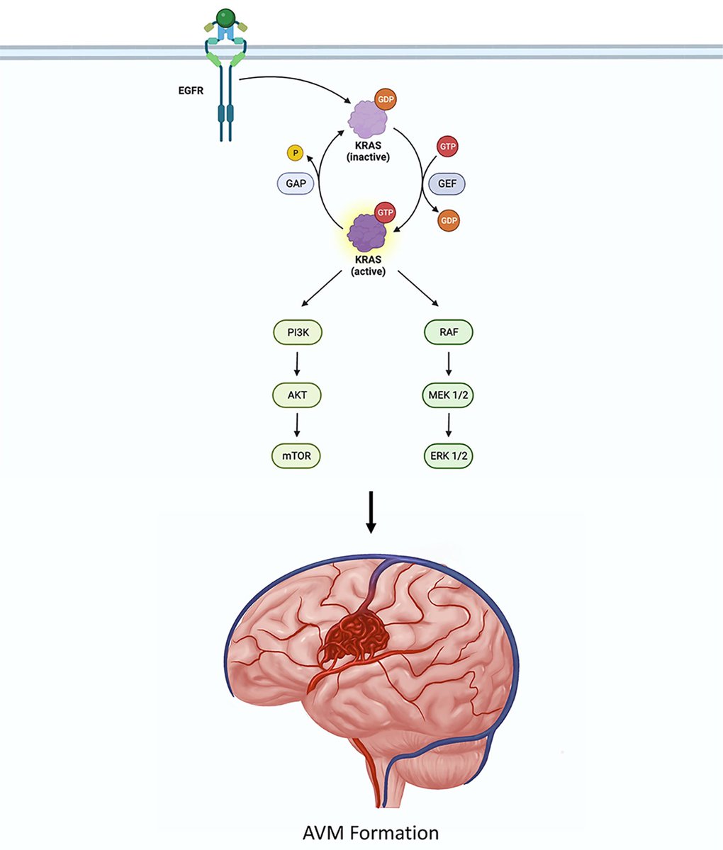 James Rutka (@jamesrutka) on Twitter photo Signaling pathway through KRAS leading to the development of pediatric cerebral AVMs. New, free article in <a href="/TheJNS/">Journal of Neurosurgery</a>, check it out: doi.org/10.3171/2024.6… Signaling pathway through KRAS leading to the development of pediatric cerebral AVMs. New, free article in <a href="/TheJNS/">Journal of Neurosurgery</a>, check it out: doi.org/10.3171/2024.6…