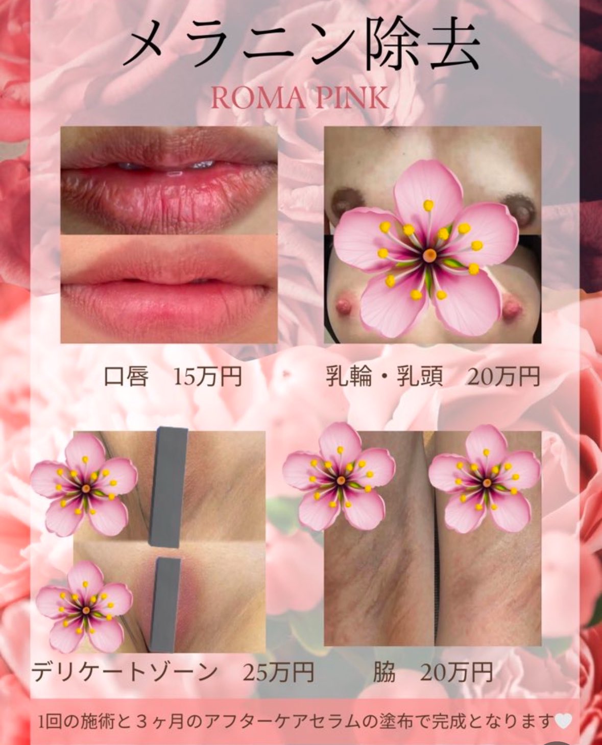 Roma Pink 正規品　施術後アフタークリーム　メラニン色素除去 ローマピンク公式販売店｜株式会社 Dr.Visea
