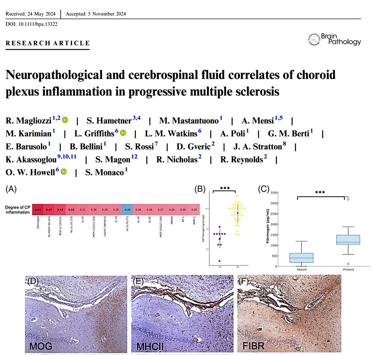 Katerina Akassoglou (@akassogloulab) on Twitter photo New paper led by <a href="/rmagliozzi73/">Roberta Magliozzi</a> we collaborated. We report #choroidplexus inflammation correlates with #fibrinogen in the CSF & subependymal periventricular areas with #microglia activation in progressive MS.
Choroid plexus inflammation represents a key component of intrathecal, New paper led by <a href="/rmagliozzi73/">Roberta Magliozzi</a> we collaborated. We report #choroidplexus inflammation correlates with #fibrinogen in the CSF & subependymal periventricular areas with #microglia activation in progressive MS.
Choroid plexus inflammation represents a key component of intrathecal,