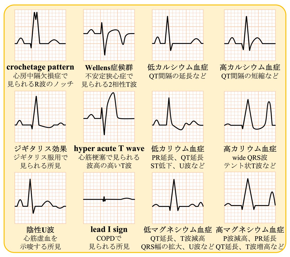 判読に役立つ色々な波形の所見、その２です。